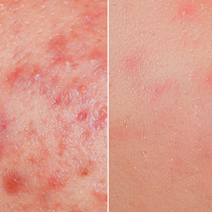 Complete Guide to Treating Acne-Prone Skin at Home