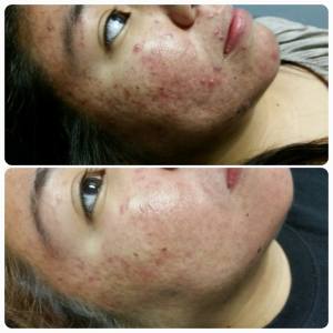 My Journey to clear my Acne with Kathy Trinh.