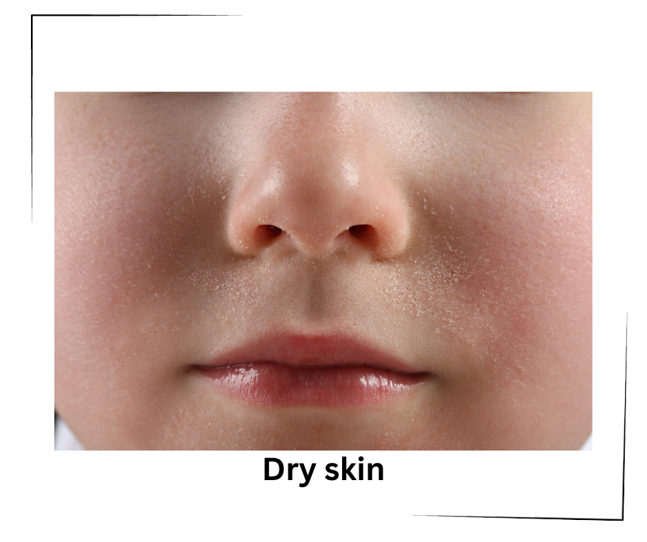 What cause dry skin and how to prevent it.