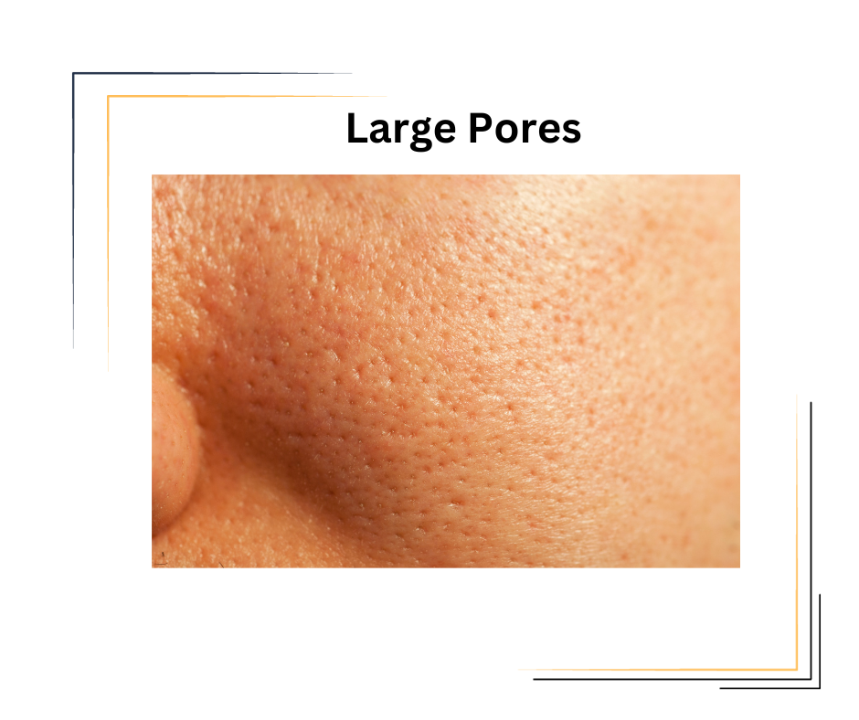 What cause large pore and to minimize them. 