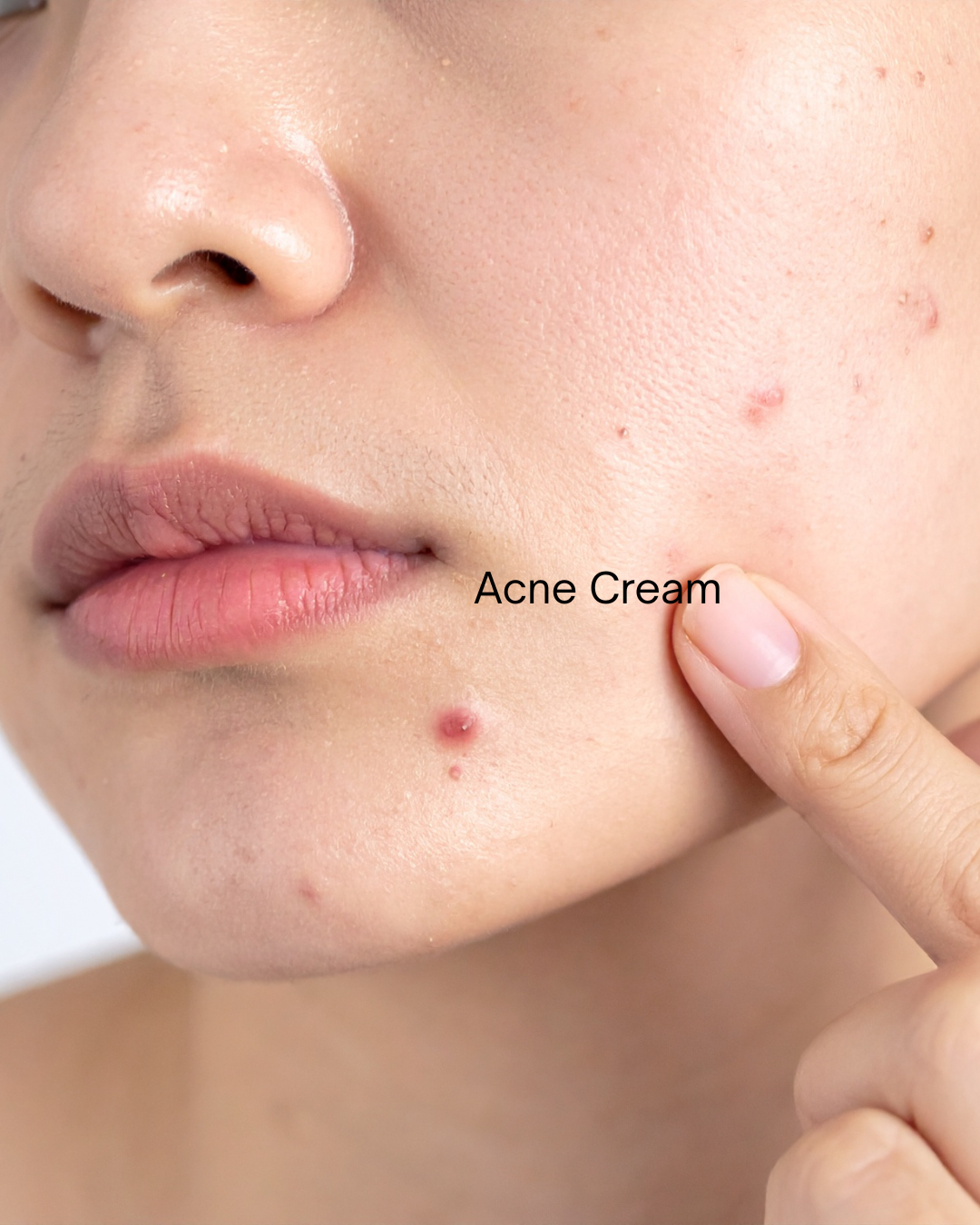 Derma.mentor AC Clear Relief Cream - Skin Essence by Kathy