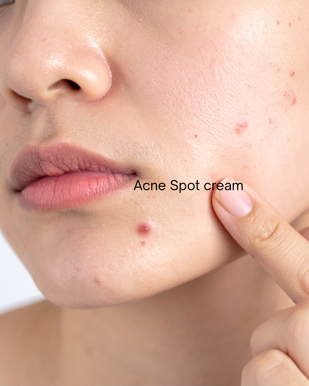 Derma.mentor AC Clear Spot Cream - Skin Essence by Kathy